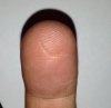 finger burn.jpg