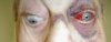 eye_eom_entrapment2.jpg