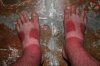 Feet sunburn.jpg