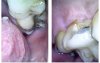 Broken tooth.jpg