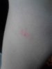 rash.jpg rash.jpg