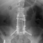 Most recent lumbar surgery result.