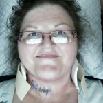 One week after double neck fusion surgery.