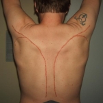 4/19/14 brand. 
This was done in 30 minutes with a cautery pen as used in the medical fields. It is a re-do of a brand I got over 15 yeears ago and it had faded badly. There was a branding demo, and I volunteered to be the demo dummy and let the artist use me to show others how to do it. The original brand was a bit bigger, and took 46 strikes with a 1 1/2" piece of sheet metal heated to red hot with a butane torch. The Cautery Pen was less painful, I hope it doesn't mean the scar will go away faster!