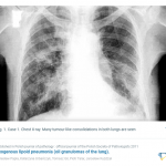 Lipoid Pneumonia Xray