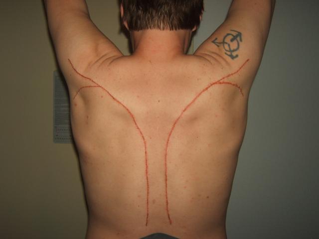 4/19/14 brand. 
This was done in 30 minutes with a cautery pen as used in the medical fields. It is a re-do of a brand I got over 15 yeears ago and it had faded badly. There was a branding demo, and I volunteered to be the demo dummy and let the artist use me to show others how to do it. The original brand was a bit bigger, and took 46 strikes with a 1 1/2" piece of sheet metal heated to red hot with a butane torch. The Cautery Pen was less painful, I hope it doesn't mean the scar will go away faster!