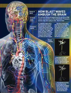 How Blast Waves Ambush the Brain

Itâ€™s not just flying shrapnel and brute force that cause concussions on the battlefield. Pressure waves may also play a role. Hereâ€™s how
An explosion begins with a powerful pulse of hot compressed gas that radiates outward, generating a wave of pressure that can travel up to 1,500 mph. The bigger the bomb, the faster and more forceful the wave. A vacuum of air trails this initial wave, creating a violent suction force that can shear organs.
But little is known about how blast waves damage the brain. Shock waves rattle the head but may also compress the torso, transferring energy to blood vessels. One theory is that the oscillating waves travel through the bloodstream and into the brain, where they twist and kill neurons over time.
Eric Hagerman is a contributing editor for Popular Science.