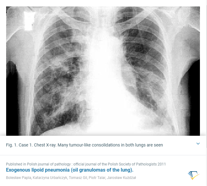 Lipoid Pneumonia Xray