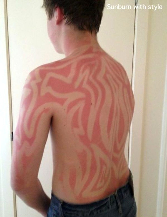 sunburn-with-style.jpg