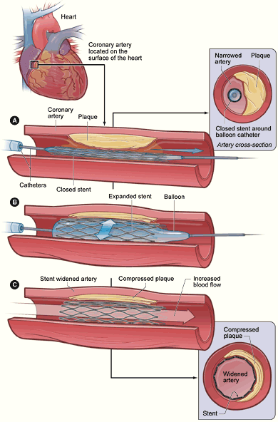 PTCA_stent_NIH.gif