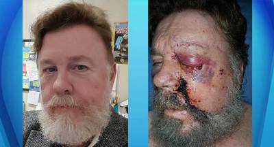 e-cig-explosion-0510161.jpg