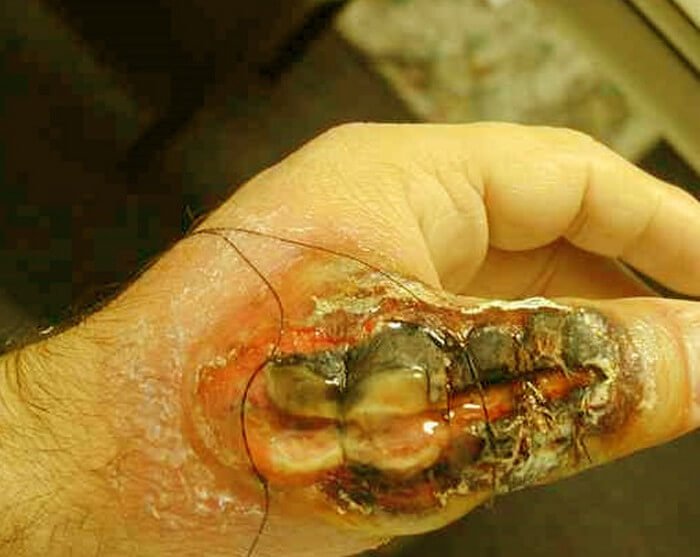 brown-recluse-spider-bite.jpg